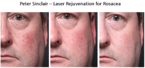 Rosacea1